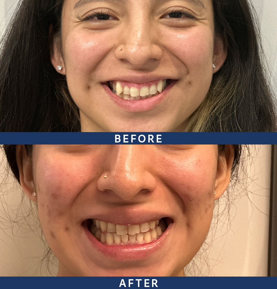 invisalign