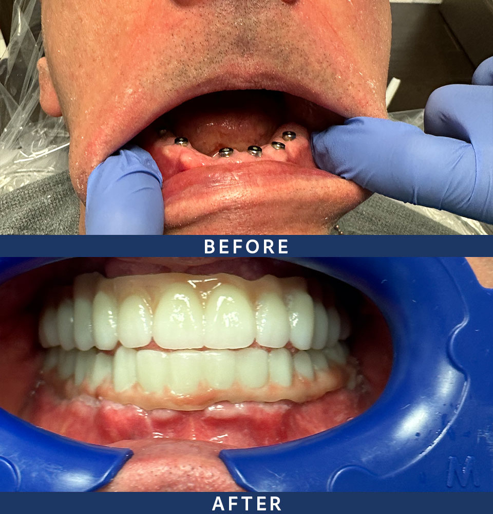 implants before after