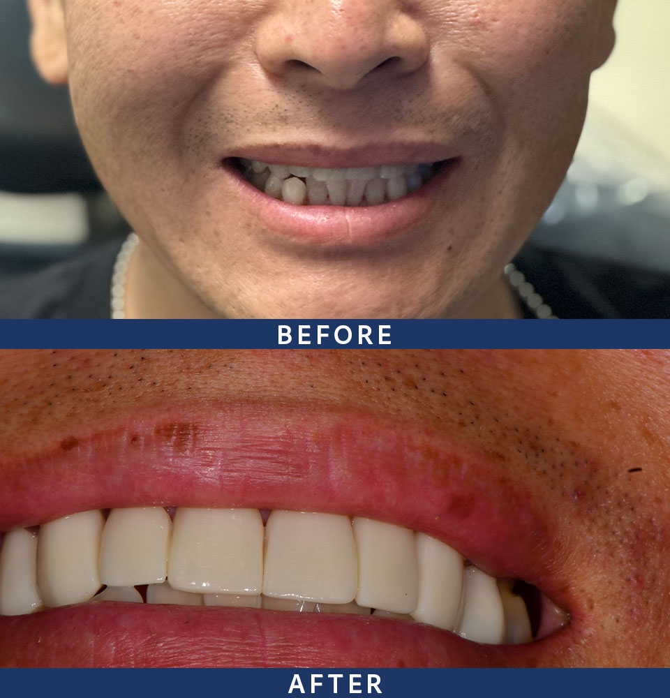 before after veneers