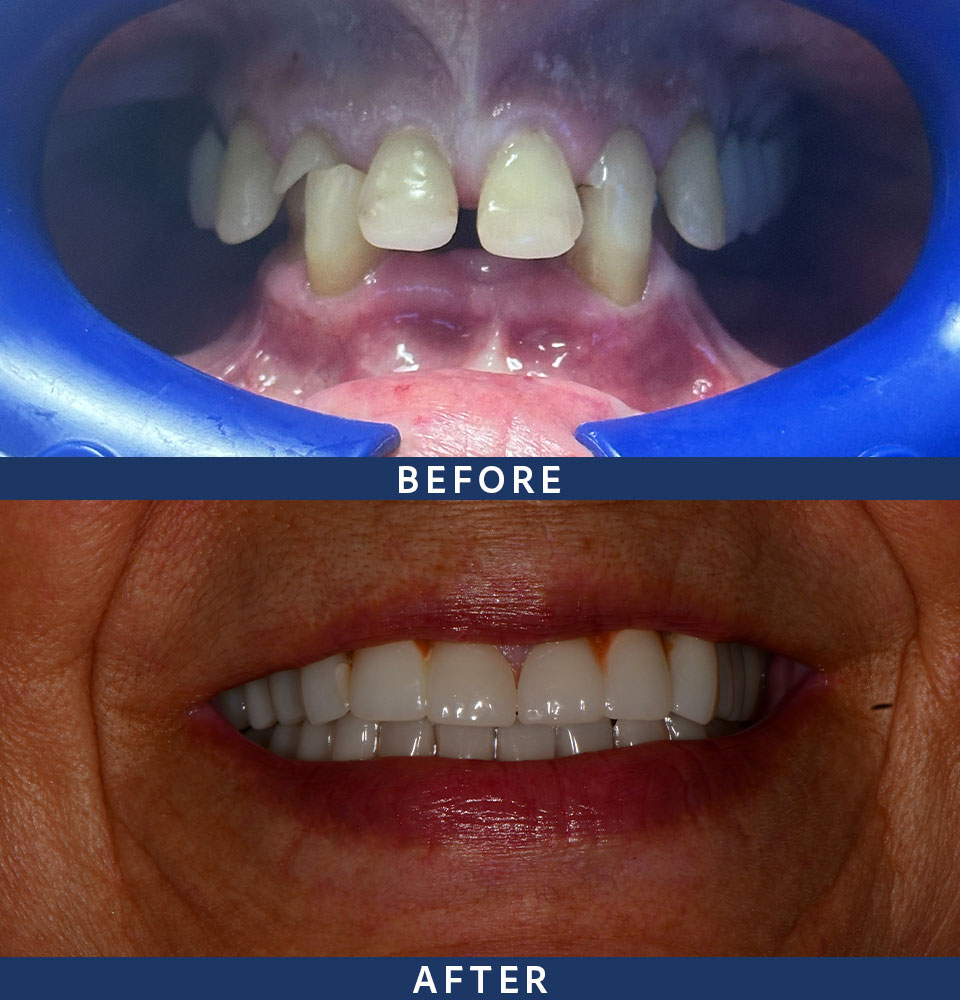 implants before after