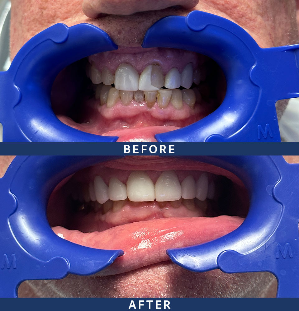 veneers