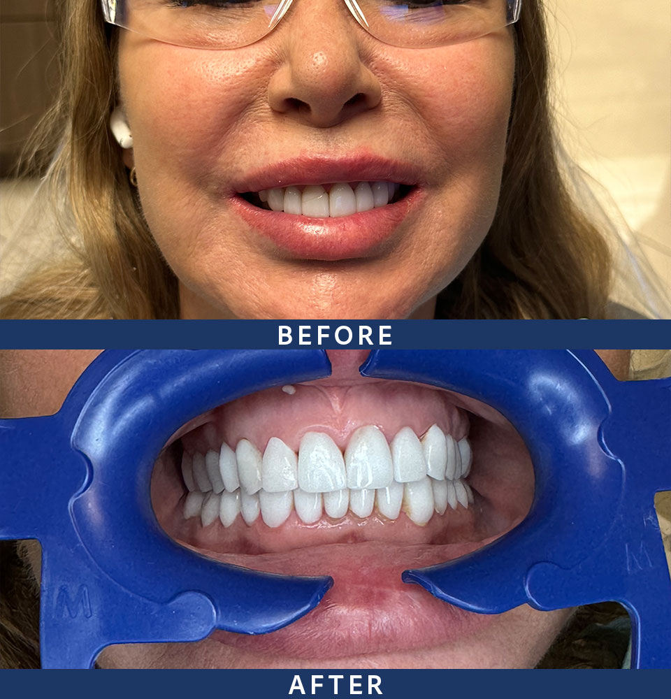 before-after veneers