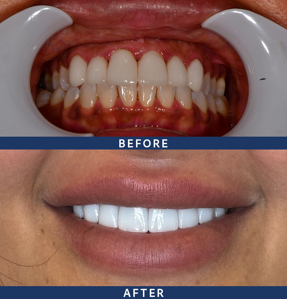 veneers before after