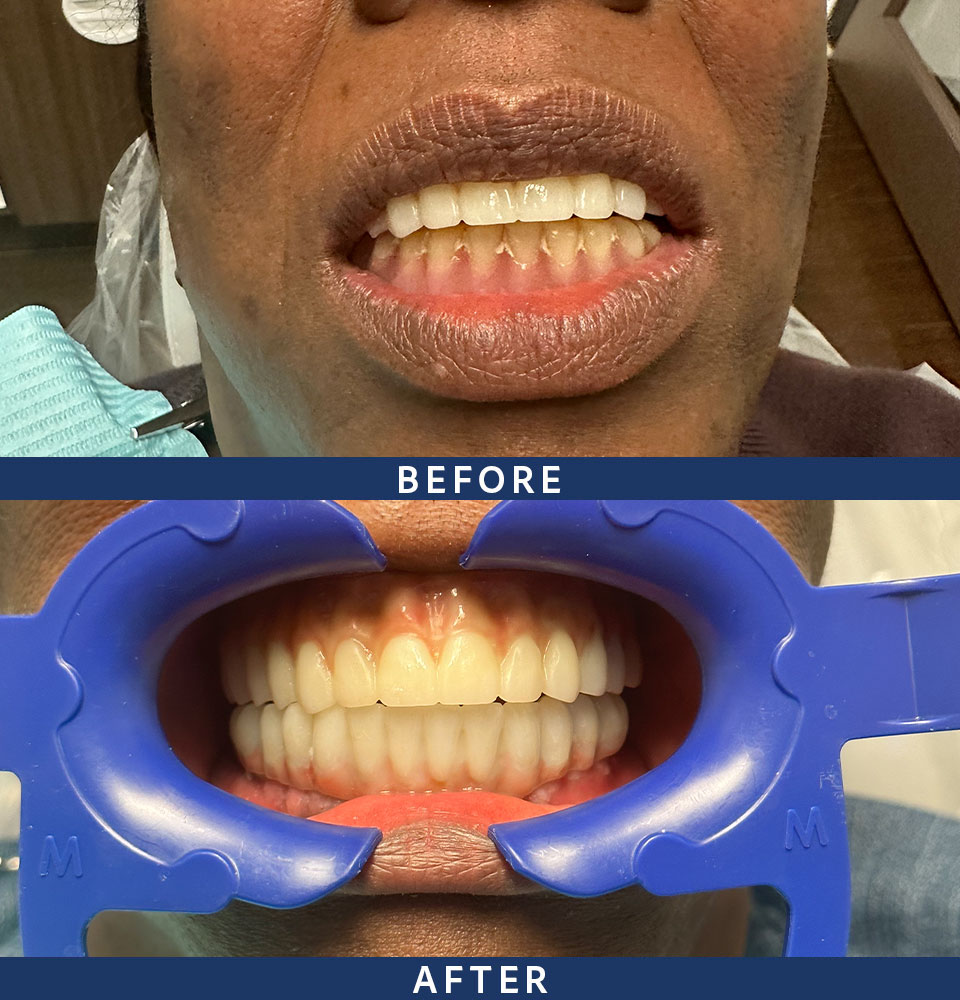 implants before-after