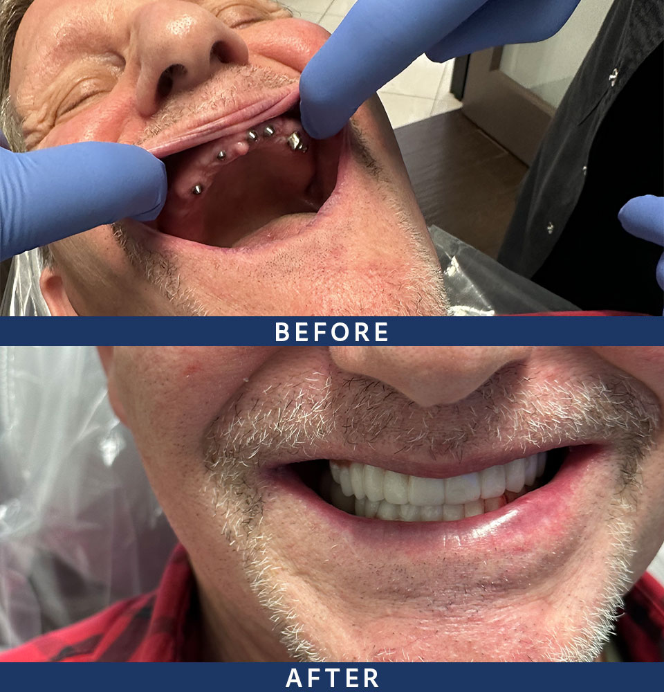 before after dental implants
