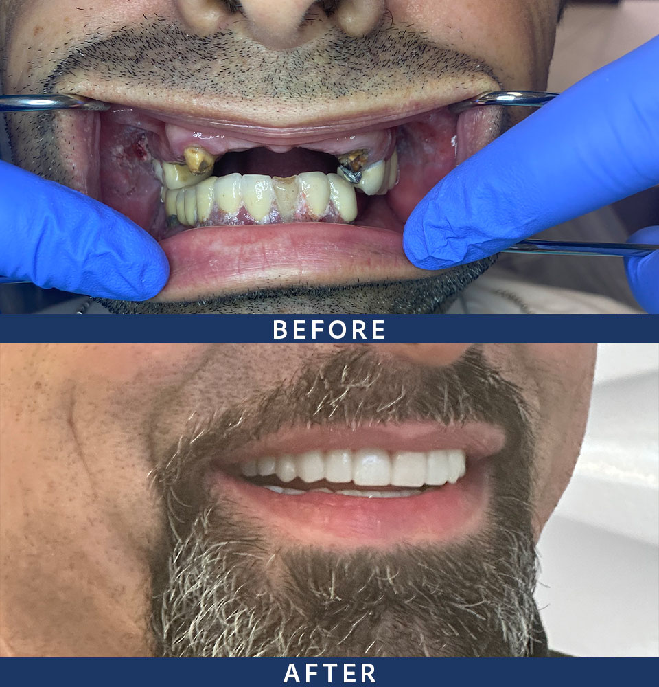 dental implants before-after