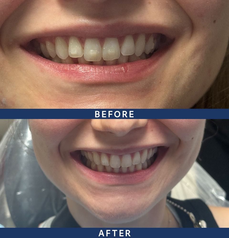 before after invisalign