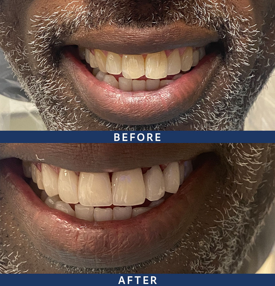 before after veneers