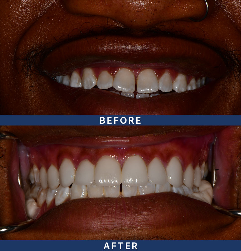 before after veneers