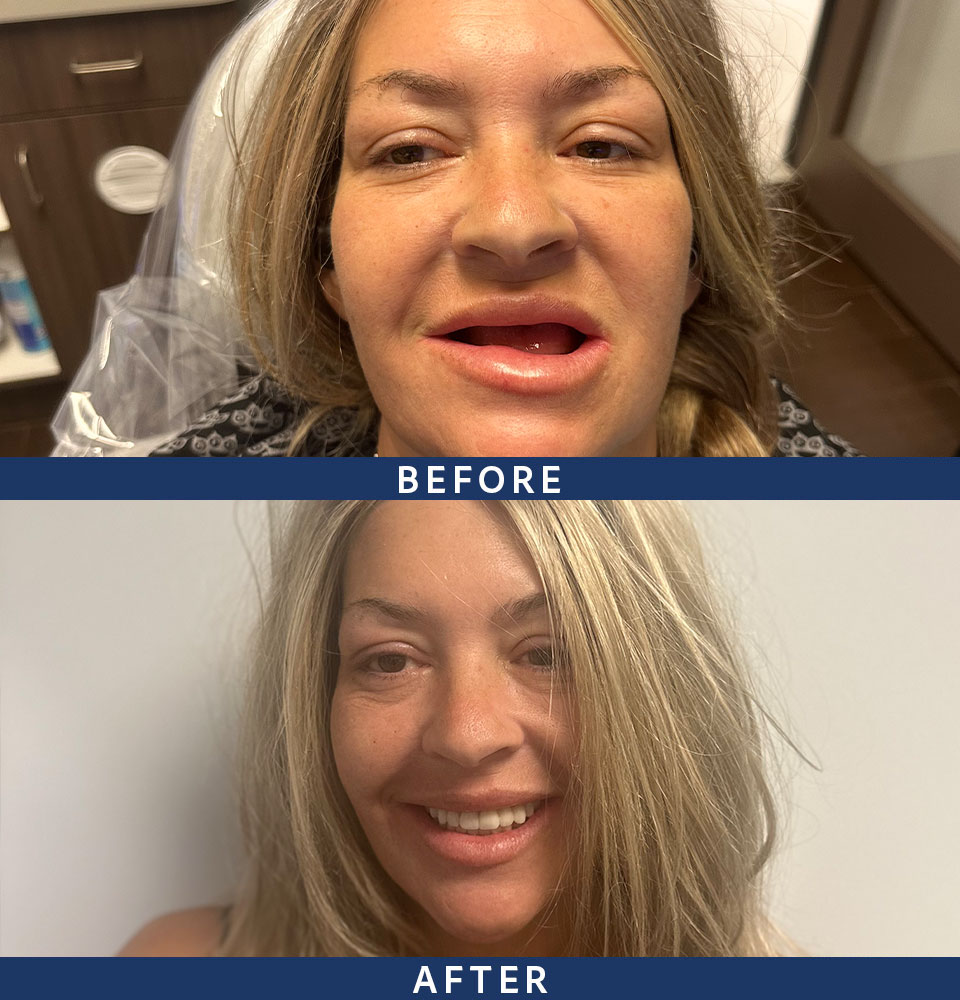 before after