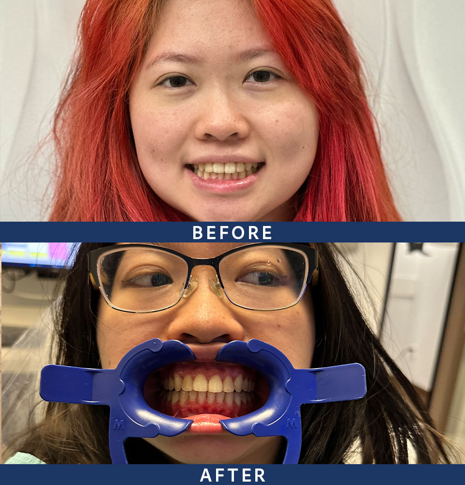 before after invisalign