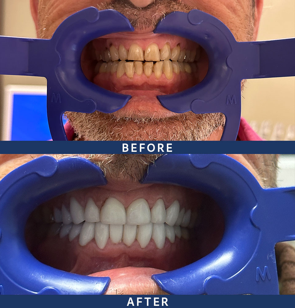 before after veneers