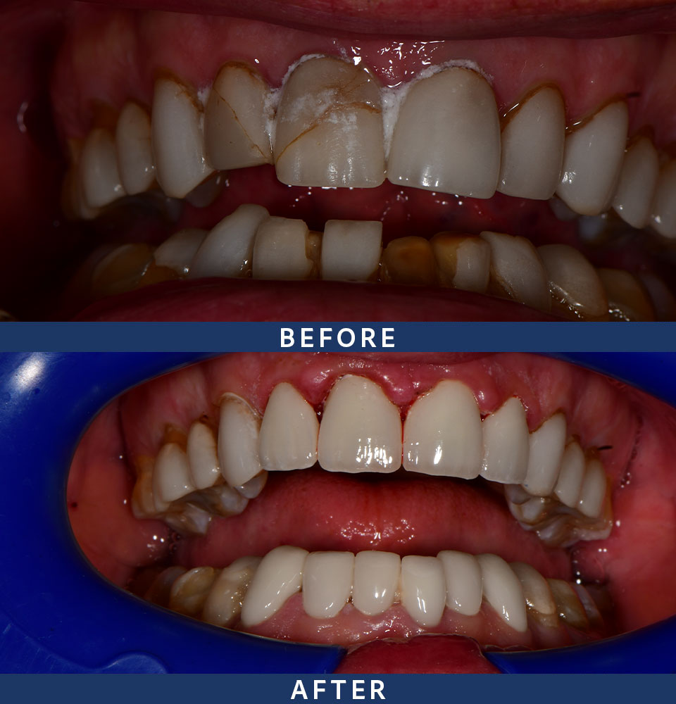 veneers before after