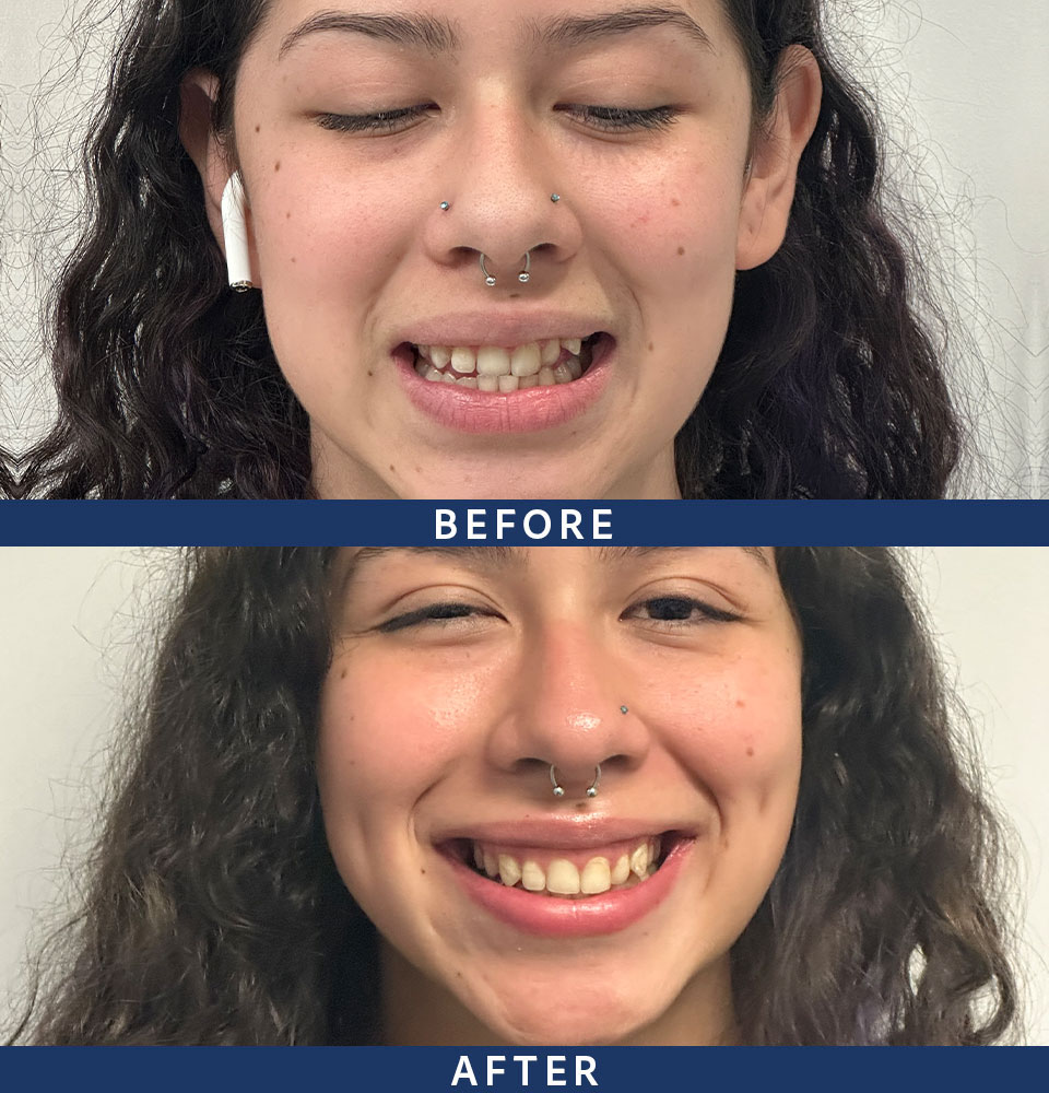 before after
