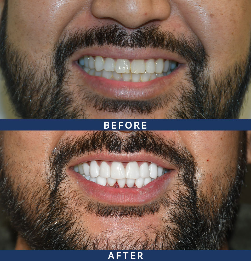 Veneers