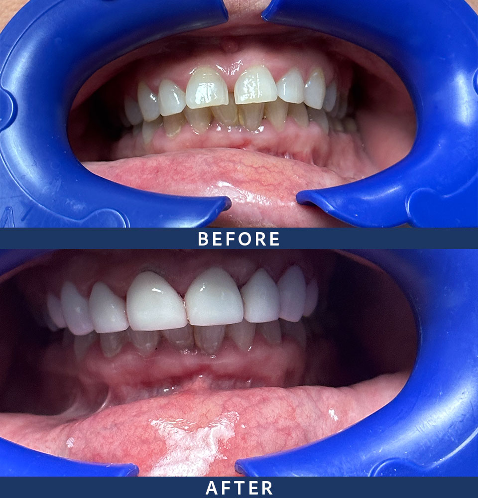 before after veneers