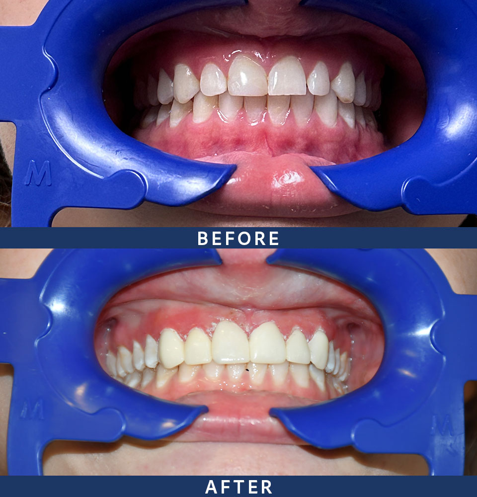 before after